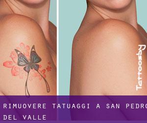 Rimuovere Tatuaggi a San Pedro del Valle