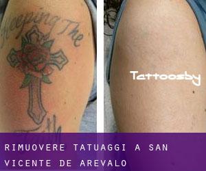 Rimuovere Tatuaggi a San Vicente de Arévalo