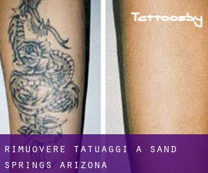 Rimuovere Tatuaggi a Sand Springs (Arizona)