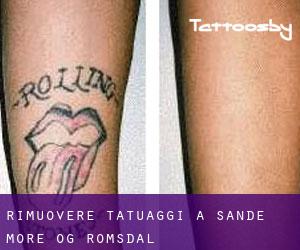 Rimuovere Tatuaggi a Sande (Møre og Romsdal)