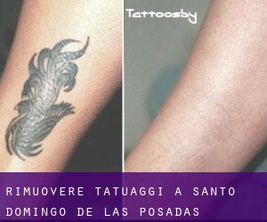 Rimuovere Tatuaggi a Santo Domingo de las Posadas