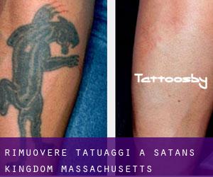Rimuovere Tatuaggi a Satans Kingdom (Massachusetts)