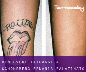 Rimuovere Tatuaggi a Schöneberg (Renania-Palatinato)