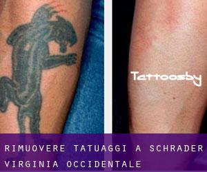 Rimuovere Tatuaggi a Schrader (Virginia Occidentale)