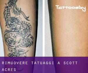 Rimuovere Tatuaggi a Scott Acres