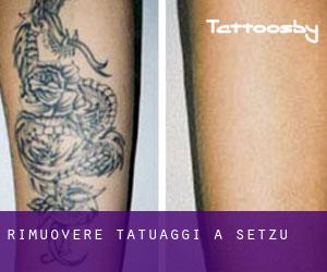 Rimuovere Tatuaggi a Setzu