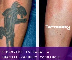 Rimuovere Tatuaggi a Shanballyoghery (Connaught)