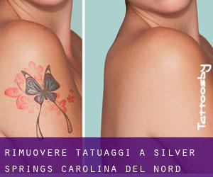 Rimuovere Tatuaggi a Silver Springs (Carolina del Nord)