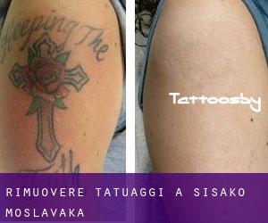 Rimuovere Tatuaggi a Sisačko-Moslavačka