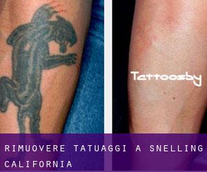 Rimuovere Tatuaggi a Snelling (California)