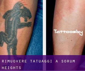 Rimuovere Tatuaggi a Sorum Heights