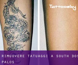 Rimuovere Tatuaggi a South Dos Palos
