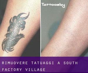 Rimuovere Tatuaggi a South Factory Village