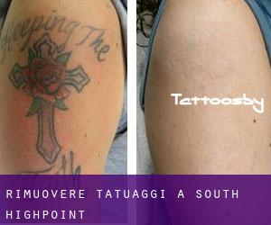 Rimuovere Tatuaggi a South Highpoint