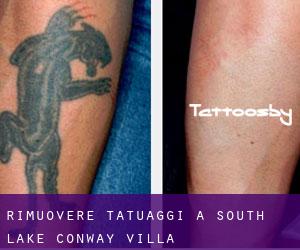 Rimuovere Tatuaggi a South Lake Conway Villa