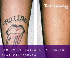 Rimuovere Tatuaggi a Spanish Flat (California)