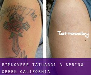 Rimuovere Tatuaggi a Spring Creek (California)