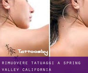 Rimuovere Tatuaggi a Spring Valley (California)