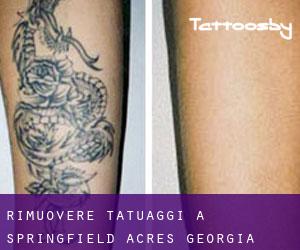 Rimuovere Tatuaggi a Springfield Acres (Georgia)