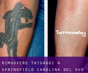 Rimuovere Tatuaggi a Springfield (Carolina del Sud)