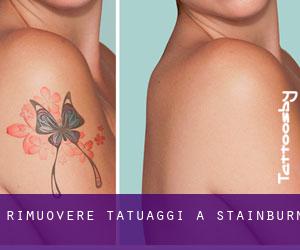 Rimuovere Tatuaggi a Stainburn