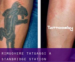 Rimuovere Tatuaggi a Stanbridge Station