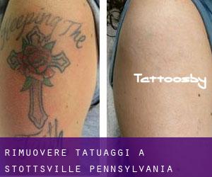 Rimuovere Tatuaggi a Stottsville (Pennsylvania)