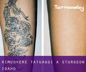 Rimuovere Tatuaggi a Sturgeon (Idaho)