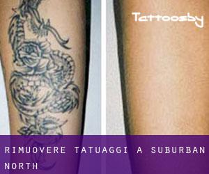 Rimuovere Tatuaggi a Suburban North