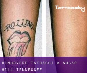 Rimuovere Tatuaggi a Sugar Hill (Tennessee)
