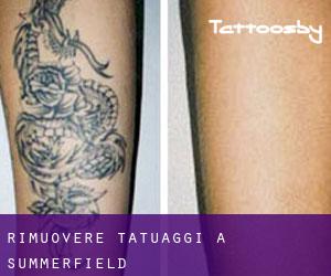 Rimuovere Tatuaggi a Summerfield