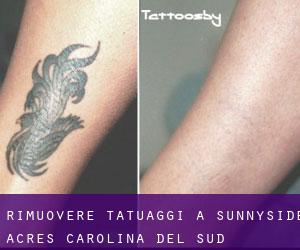 Rimuovere Tatuaggi a Sunnyside Acres (Carolina del Sud)