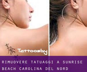 Rimuovere Tatuaggi a Sunrise Beach (Carolina del Nord)
