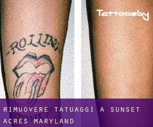 Rimuovere Tatuaggi a Sunset Acres (Maryland)