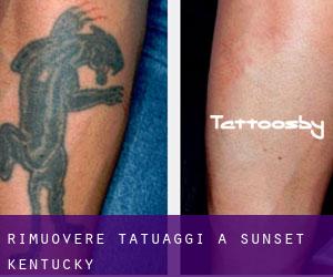 Rimuovere Tatuaggi a Sunset (Kentucky)