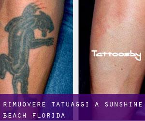 Rimuovere Tatuaggi a Sunshine Beach (Florida)