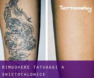Rimuovere Tatuaggi a Świętochłowice