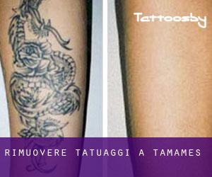 Rimuovere Tatuaggi a Tamames