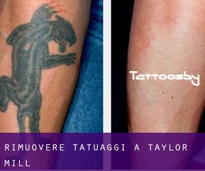 Rimuovere Tatuaggi a Taylor Mill