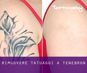 Rimuovere Tatuaggi a Tenebrón