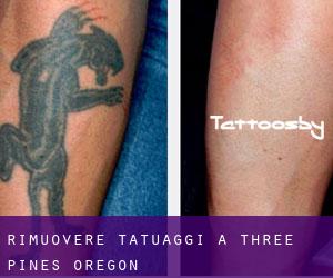Rimuovere Tatuaggi a Three Pines (Oregon)