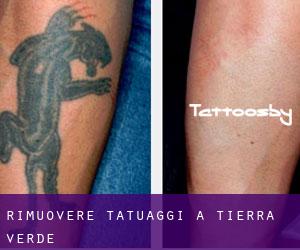 Rimuovere Tatuaggi a Tierra Verde