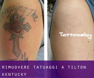 Rimuovere Tatuaggi a Tilton (Kentucky)