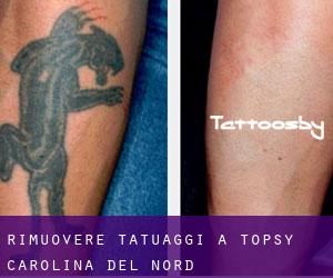 Rimuovere Tatuaggi a Topsy (Carolina del Nord)