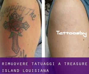 Rimuovere Tatuaggi a Treasure Island (Louisiana)