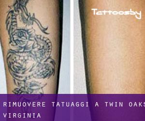 Rimuovere Tatuaggi a Twin Oaks (Virginia)