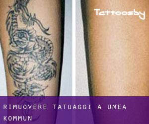 Rimuovere Tatuaggi a Umeå Kommun