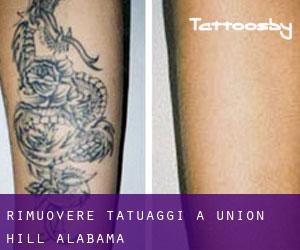 Rimuovere Tatuaggi a Union Hill (Alabama)