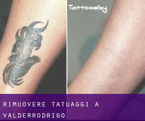 Rimuovere Tatuaggi a Valderrodrigo