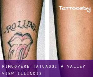 Rimuovere Tatuaggi a Valley View (Illinois)